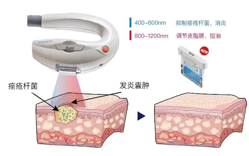 Acne痤疮焦点注册作用